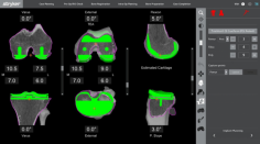 How Can Robotic Partial Knee Replacement Surgery Benefit You?

In this world filled with all the modern technology, robotic assisted partial knee replacement surgery has been proven to be more accurate to implant the positioning than conventional partial knee replacements. Few of the advantages in getting a robotic partial knee replacement surgery are:

 

* Enhances precision and accuracy during surgery
* Uses minimally invasive approach
* Improves implant’s longevity
* Reduces risk of surgical complications

 

For the partial knee replacement surgery, we use Stryker Restoris robot, and it has a long track record and have excellent results on the Australian Orthopaedic Association National Joint Replacement Registry.