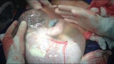 This photograph has been doing the rounds on social media for the last few months, but what's really going on?  A Greek doctor snapped this amazing image during a caesarian section. Unusually, the amniotic sac remained intact as the birth progressed. Typically it breaks, but this time it did not -leading to the baby not even being aware it had been born. Until the amniotic sac breaks, the baby will continue to receive oxygen and nutrients from the placenta.  This baby was born safe and healthy.