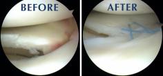 Exceptional Care for Torn Meniscus Repair

Choosing the right specialist is crucial for effective torn meniscus repair and long-lasting results. Mr Vishal Pai is dedicated to providing expert care, ensuring your knee health is restored with precision and compassion. Here’s why you should choose us:  



* Extensive experience in diagnosing and treating torn meniscus injuries. 
* Utilises state-of-the-art keyhole surgery methods for optimal recovery. 
* Treatment tailored to suit individual knee conditions and lifestyles. 
* Successful outcomes with high patient satisfaction. 
* Guidance through every step, from surgery to recovery. 



Take the first step towards pain-free movement. Contact us today! 