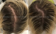 Regrow Hair Naturally with Herbal Treatments
Hairfall issue can be overwhelming. It caused by stress, hormonal imbalances, poor nutrition and sometimes also due to excessive heat styling and using harsh hair products. At Australian Hair & Scalp Clinics, we specialise in natural hair regrowth through our reliable Herbal Follicular Activation (HFA) process. This non-invasive treatment helps reverse follicle miniaturisation and promotes healthy hair growth.

Stop Excessive Hair Loss: Clean and unblock scalp pores for optimal growth.
Nourish Hair Follicles: Provide essential nutrients to activate dormant follicles.
Maintain Scalp Health: Balance pH levels and reduce inflammation.
Achieve safe and effective results without harsh chemicals or side effects. Contact us today to start your journey to healthier hair!
